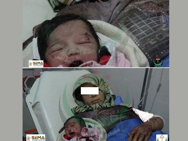 বোমার টুকরো মাথায় নিয়েই সিরিয়ায় জন্ম নিল 'মিরাকেল বেবি' বোমার টুকরো মাথায় নিয়েই সিরিয়ায় জন্ম নিল 'মিরাকেল বেবি'