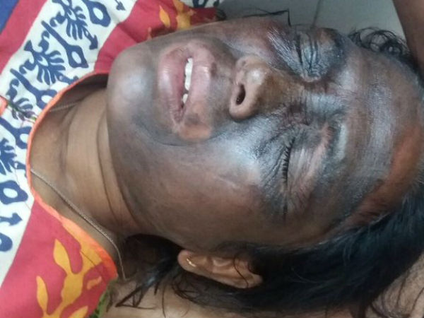 অ্যাসিড হামলা