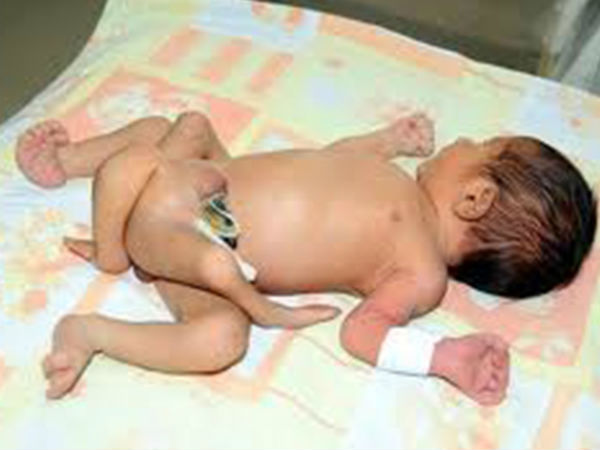 চার পা নিয়ে জন্মাল শিশু, ভারতের কোথায় ঘটল এমন বিরল ঘটনা, জানুন বিস্তারিত চার পা নিয়ে জন্মাল শিশু, ভারতের কোথায় ঘটল এমন বিরল ঘটনা, জানুন বিস্তারিত