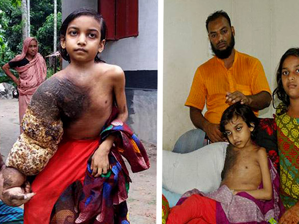 বিরল রোগে আক্রান্ত বাংলাদেশের কিশোরী বিরল রোগে আক্রান্ত বাংলাদেশের কিশোরী