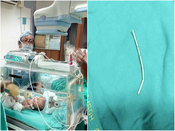 ৩ দিনের শিশুর হৃদযন্ত্রে ভাঙা ক্যাথিটার পাইপ, প্রাণ বাঁচল এসএসকেএম-এর চিকিৎসকদের প্রচেষ্টায় ৩ দিনের শিশুর হৃদযন্ত্রে ভাঙা ক্যাথিটার পাইপ, প্রাণ বাঁচল এসএসকেএম-এর চিকিৎসকদের প্রচেষ্টায়
