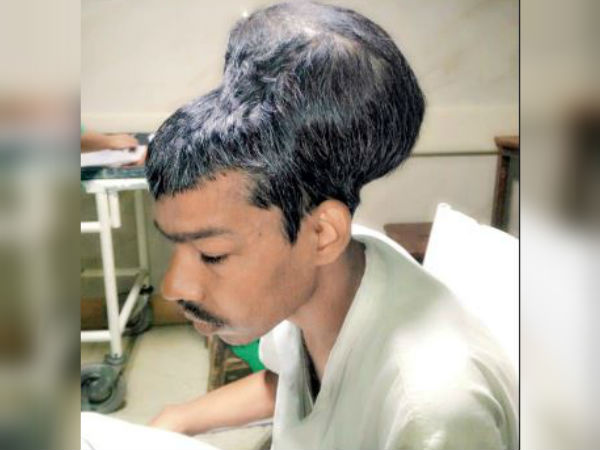 বিশ্বের সবচেয়ে বড় ব্রেন টিউমারের সফল অস্ত্রোপচার মুম্বইয়ে বিশ্বের সবচেয়ে বড় ব্রেন টিউমারের সফল অস্ত্রোপচার মুম্বইয়ে