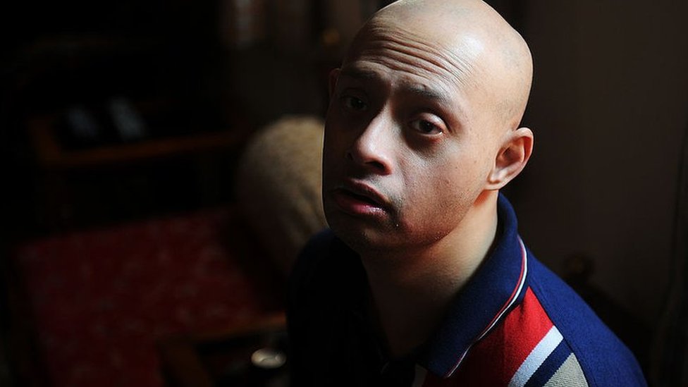 ডাউন সিনড্রোম ডাউন সিনড্রোম